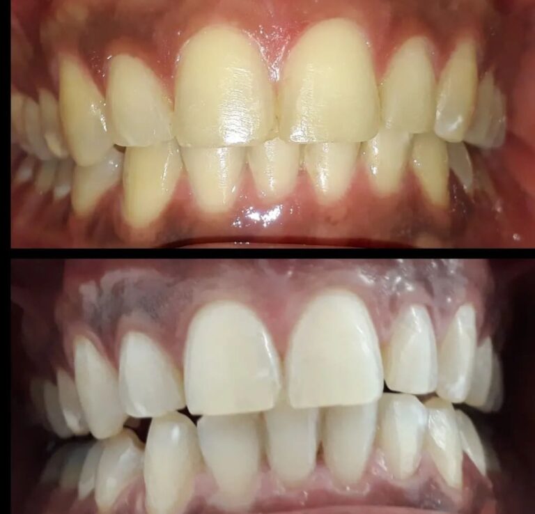 Clareamento Dental